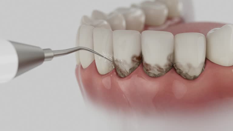 Trusted Wisdom Tooth Removal service in Bermuda Dunes, CA - Dentist Open Now
